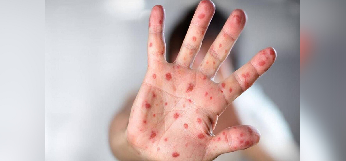 मङ्कीपक्स भाइरसको सङ्क्रमण नेपालमा पहिलोपटक पुष्टि